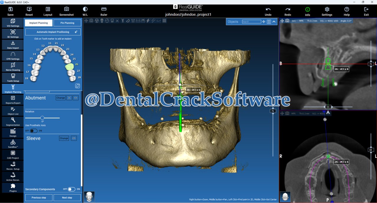 RealGuide V6 Implant Suite Main Interface